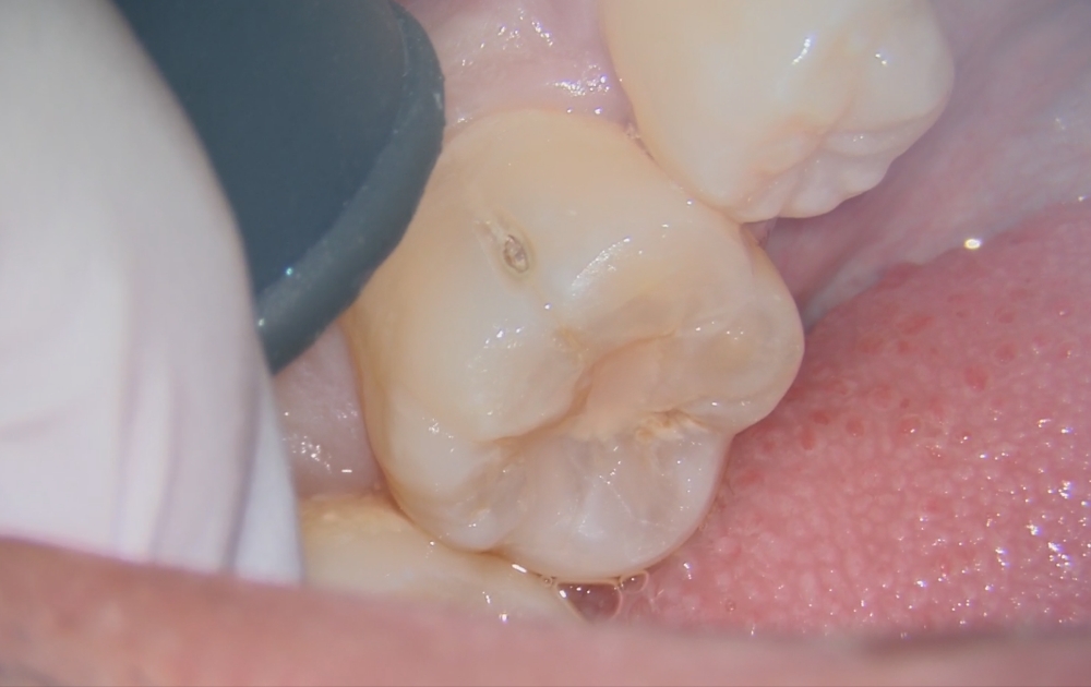 1.削る前の最初の状態です。表面にはごく小さな穴が開いているだけですが、この段階では内部の広がりは外から判断できません。