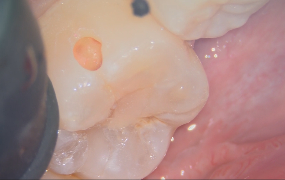 2.外側を少しずつ削ることで、内側に広く虫歯が進行していることが分かります。見た目以上に深いケースも多く、慎重な確認が必要です。