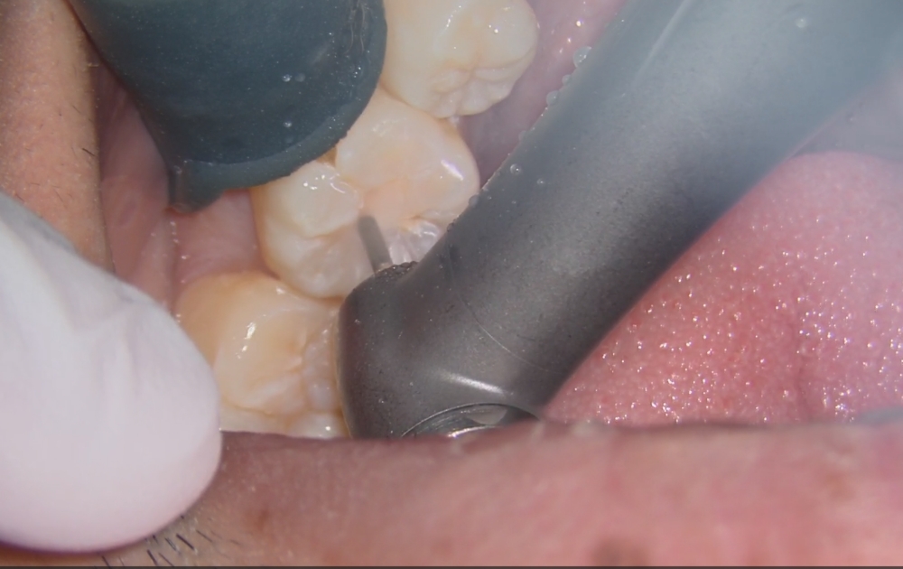 3.噛み合わせの面にある古いプラスチック（レジン）を外していきます。過去の治療部分を丁寧に取り除き、内部の状態を確認します。