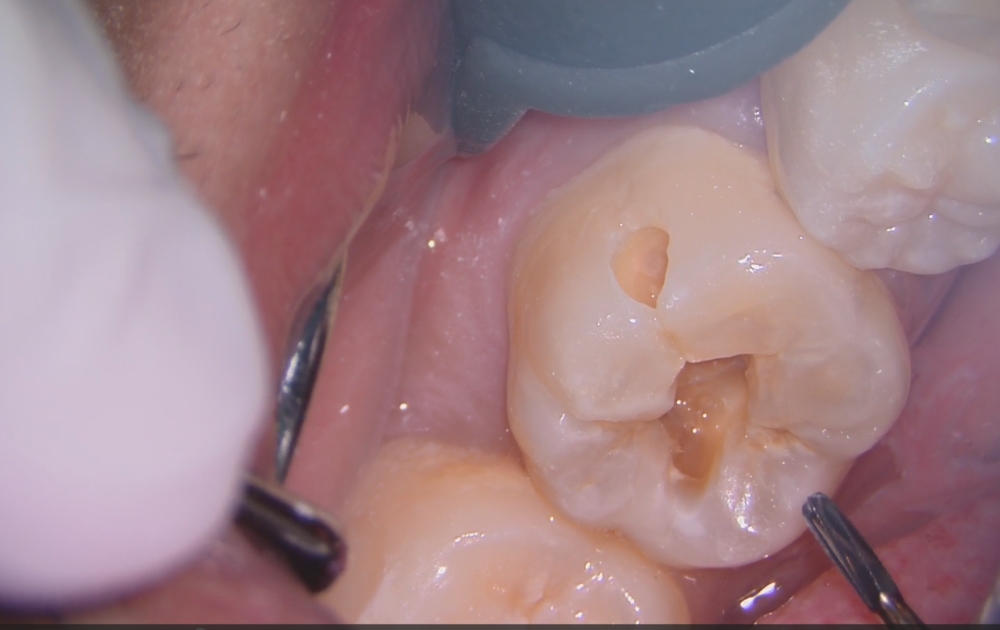 4.プラスチックの下でも虫歯が進行していることがあります。見えない部分にも広がっているため、しっかり取り除くことが重要です。