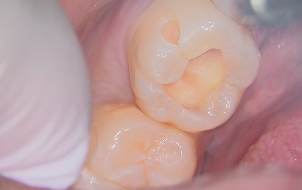 5.虫歯を取り切った状態です。マイクロスコープなど拡大視野を活用し、取り残しがないか細部まで確認します。