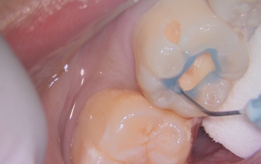 6.再度プラスティックを充填するために、歯の表面処理を行います。充填物がしっかり接着し、長持ちするよう下準備を整えます。