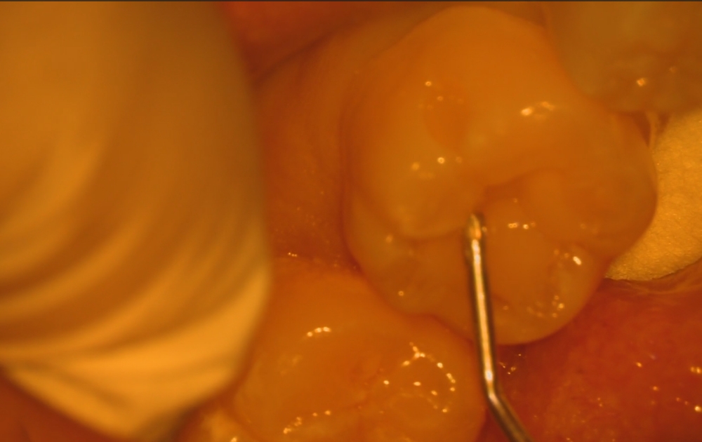 7.プラスチック（レジン）を充填していきます。歯本来の形に近づけるため、噛み合わせや凹凸を意識しながら慎重に盛り上げていきます。