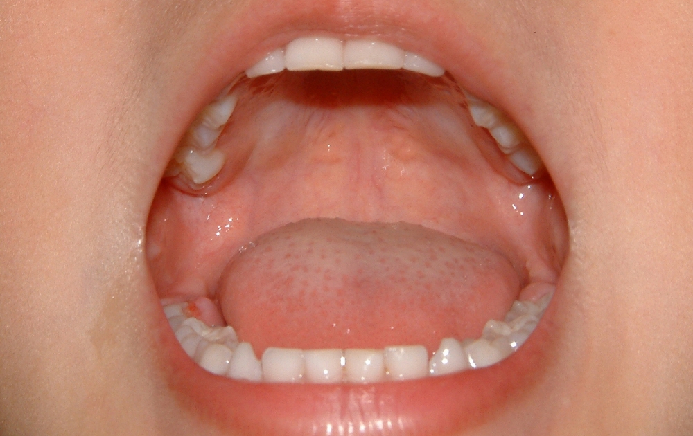 口腔内トラブルが少ない